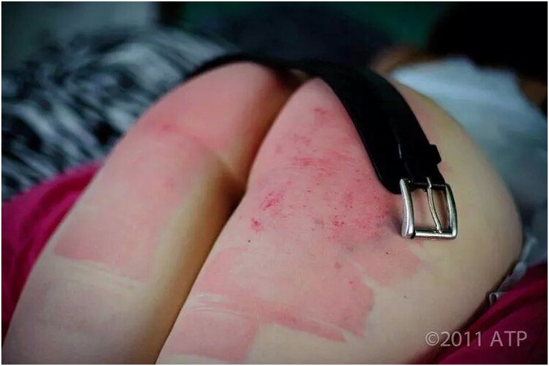 bottom covered in red welts from a vigorous belt spanking