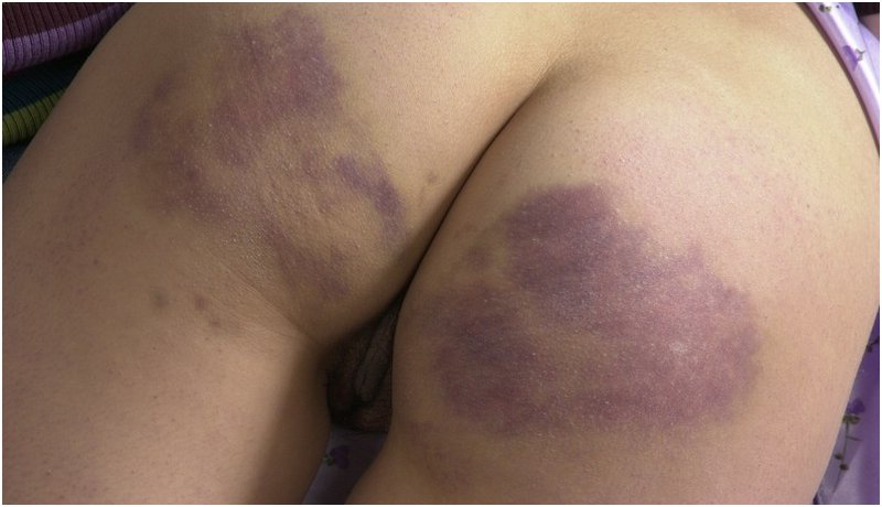 teen brandi paddled bottom with spanking bruises