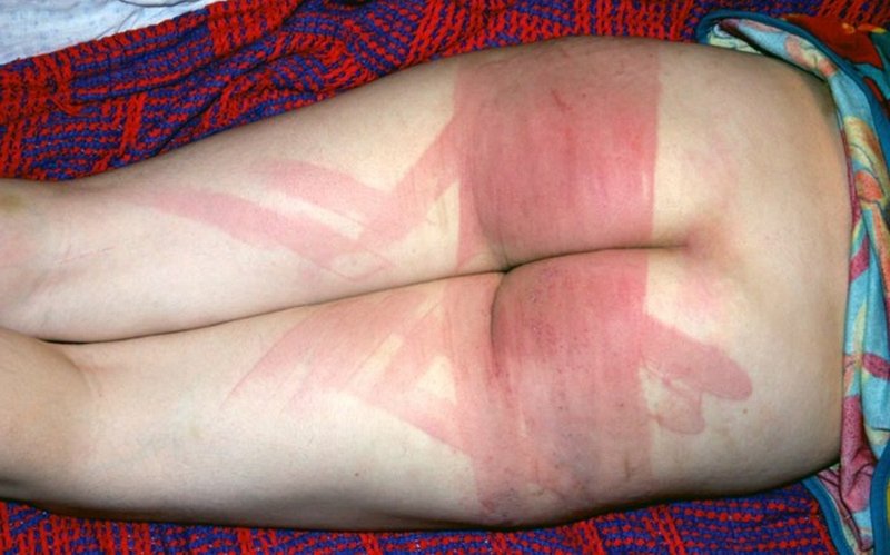 spanked bottom turned very red with vivid marks from a harsh spanking with a leather belt