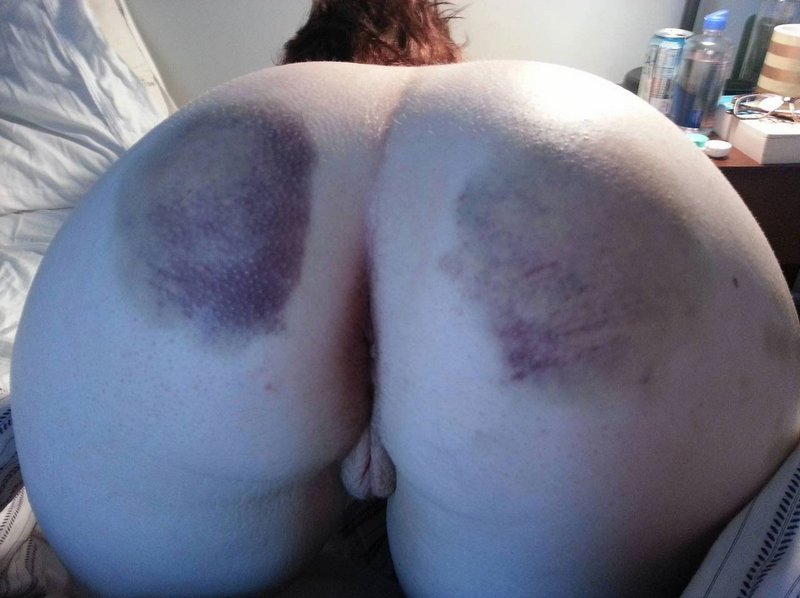 bruised ass after a spanking, lube bottle open and ready to fuck